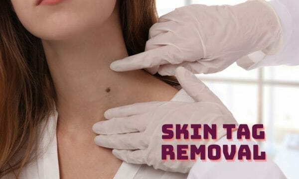 skin tag removal