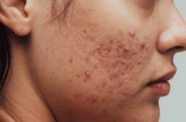 Acne on Chin 17 0fc313ca4ac24be8974ffe1134209bab 0fc313ca4ac24be8974ffe1134209bab