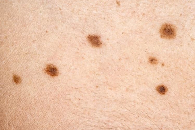 Skin Cancer Symptoms 21 321457ab27024c93931c5bbc15216c3e 321457ab27024c93931c5bbc15216c3e