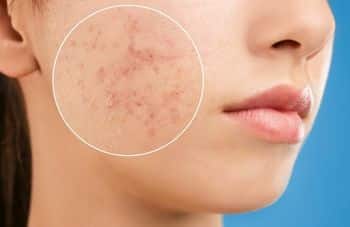 Acne on Cheeks 14 372a20f1673246738db044903ce2b061 372a20f1673246738db044903ce2b061