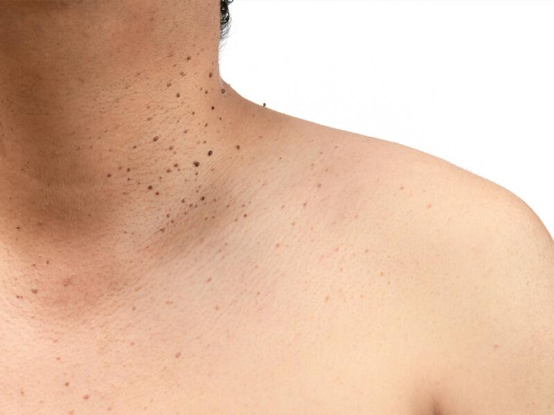 What Causes Skin Tags 13 4fbefe9136884fadb6089da4d86aa27e 4fbefe9136884fadb6089da4d86aa27e