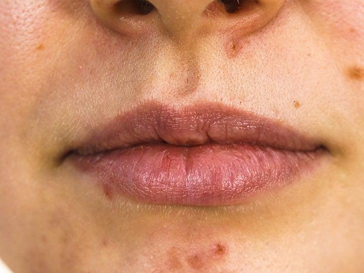 Acne around Mouth 16 61a76eb36132447cb1d5d01f7a6dbd63 61a76eb36132447cb1d5d01f7a6dbd63