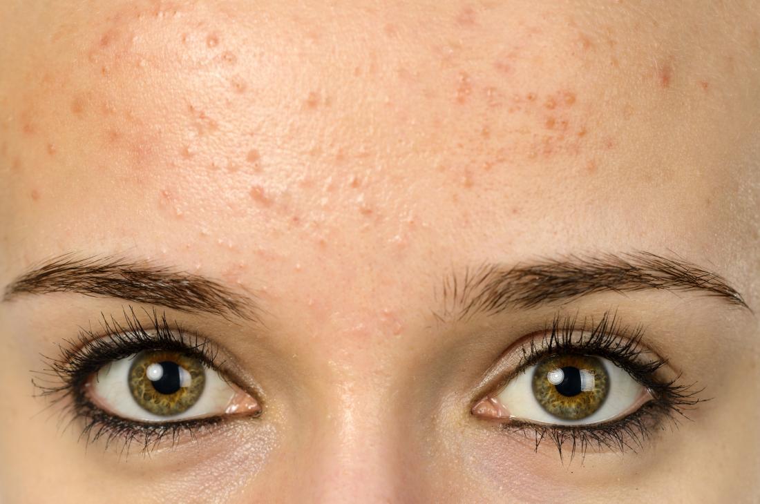 Acne on Forehead 13 8246cf0ef98049d2900f8e0cb771e9a9 8246cf0ef98049d2900f8e0cb771e9a9