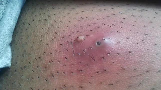 How to Get Rid of Ingrown Hair 7 a89a2b0b375648fe8adbc0bdae7a991e a89a2b0b375648fe8adbc0bdae7a991e