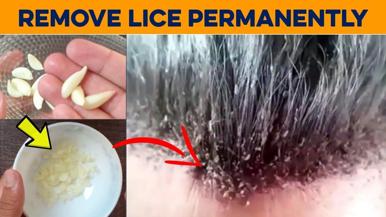 How to Remove Lice from Hair Permanently 1 d0dc8f5c17714999b17bbc0cdc6e4fdc d0dc8f5c17714999b17bbc0cdc6e4fdc