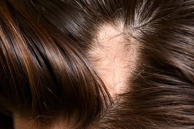 What Kind of Infections Cause Hair Loss? 8 09a1694aeb7646bfa09bdeb9d8cc4ddf 09a1694aeb7646bfa09bdeb9d8cc4ddf