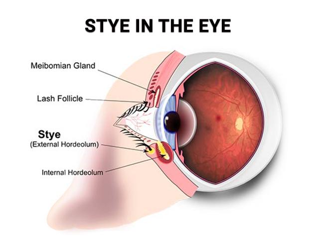 How to Take Care of a Stye in Your Eye 10 118d69000a1749d6bc1d44abb6b00446 118d69000a1749d6bc1d44abb6b00446