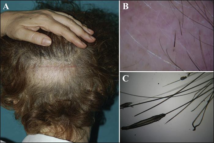 What is Dystrophic Hair? 6 28d52f076bf8427ba74d63a7976ed719 28d52f076bf8427ba74d63a7976ed719