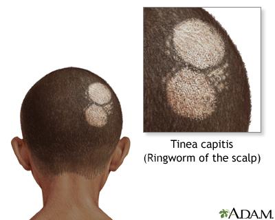 How Do You Know If You Have a Fungal Infection in Your Hair? 3 35a78308a3b349e5a878951874fcb55e 35a78308a3b349e5a878951874fcb55e