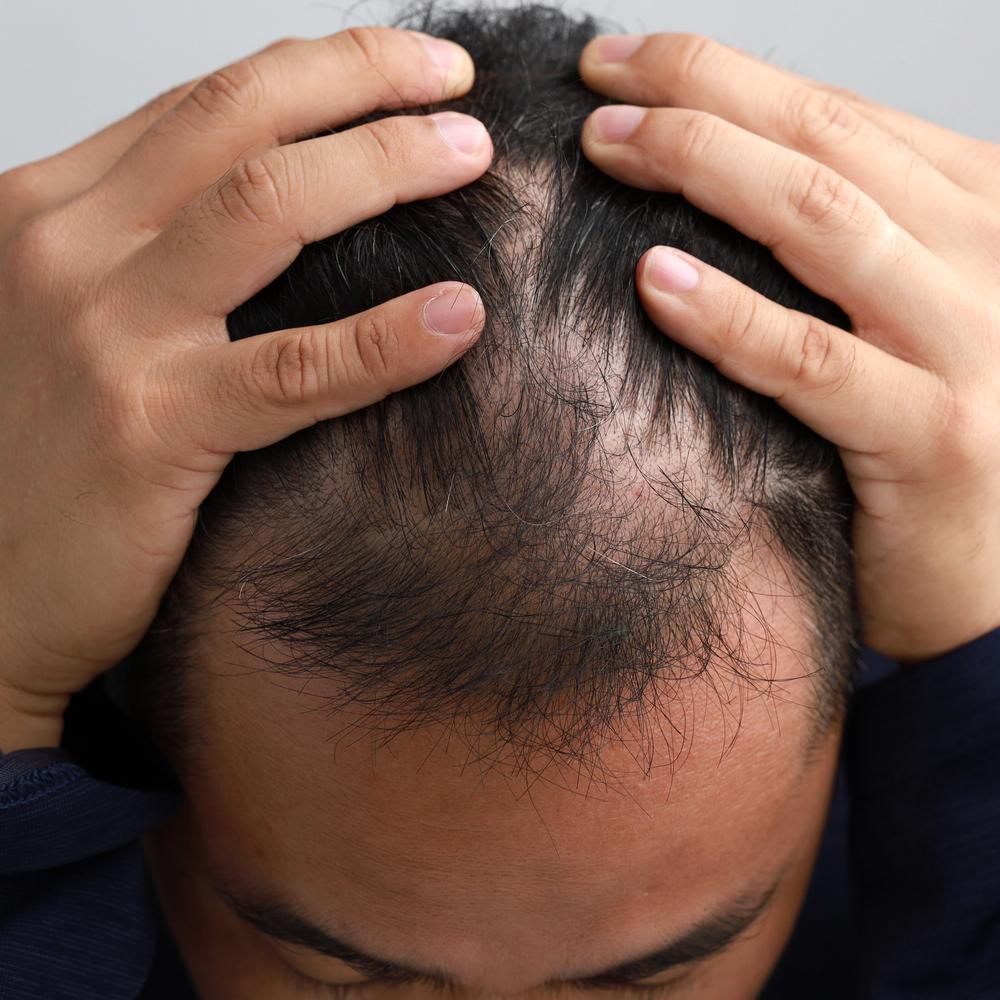 Is Alopecia Caused by Stress? 13 44511f94015849dd9e3117a236f0e612 44511f94015849dd9e3117a236f0e612