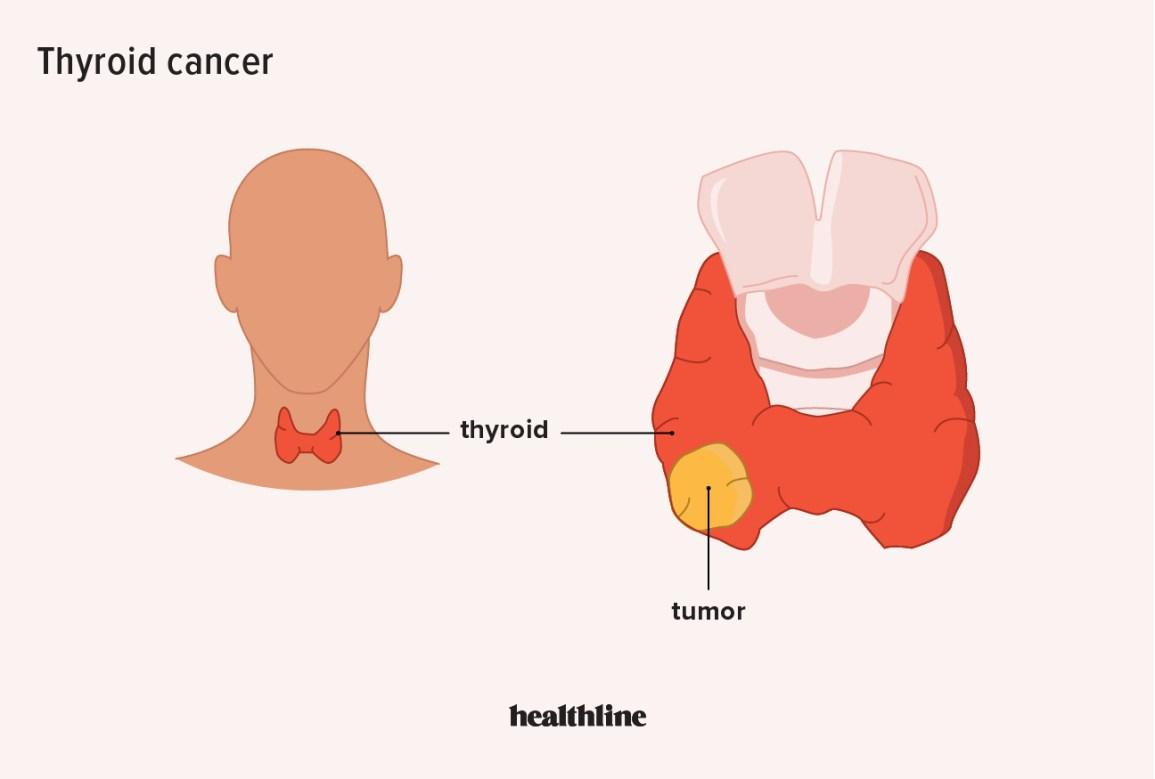 Thyroid Cancer Symptoms 15 5b66f37ab3854514bc983e222a3112a7 5b66f37ab3854514bc983e222a3112a7