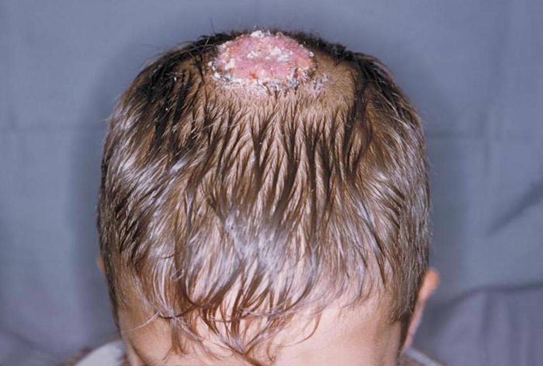 What Type of Scalp Infections are There? 1 5cb1420c52544e1ba4aa8f635b007aa2 5cb1420c52544e1ba4aa8f635b007aa2