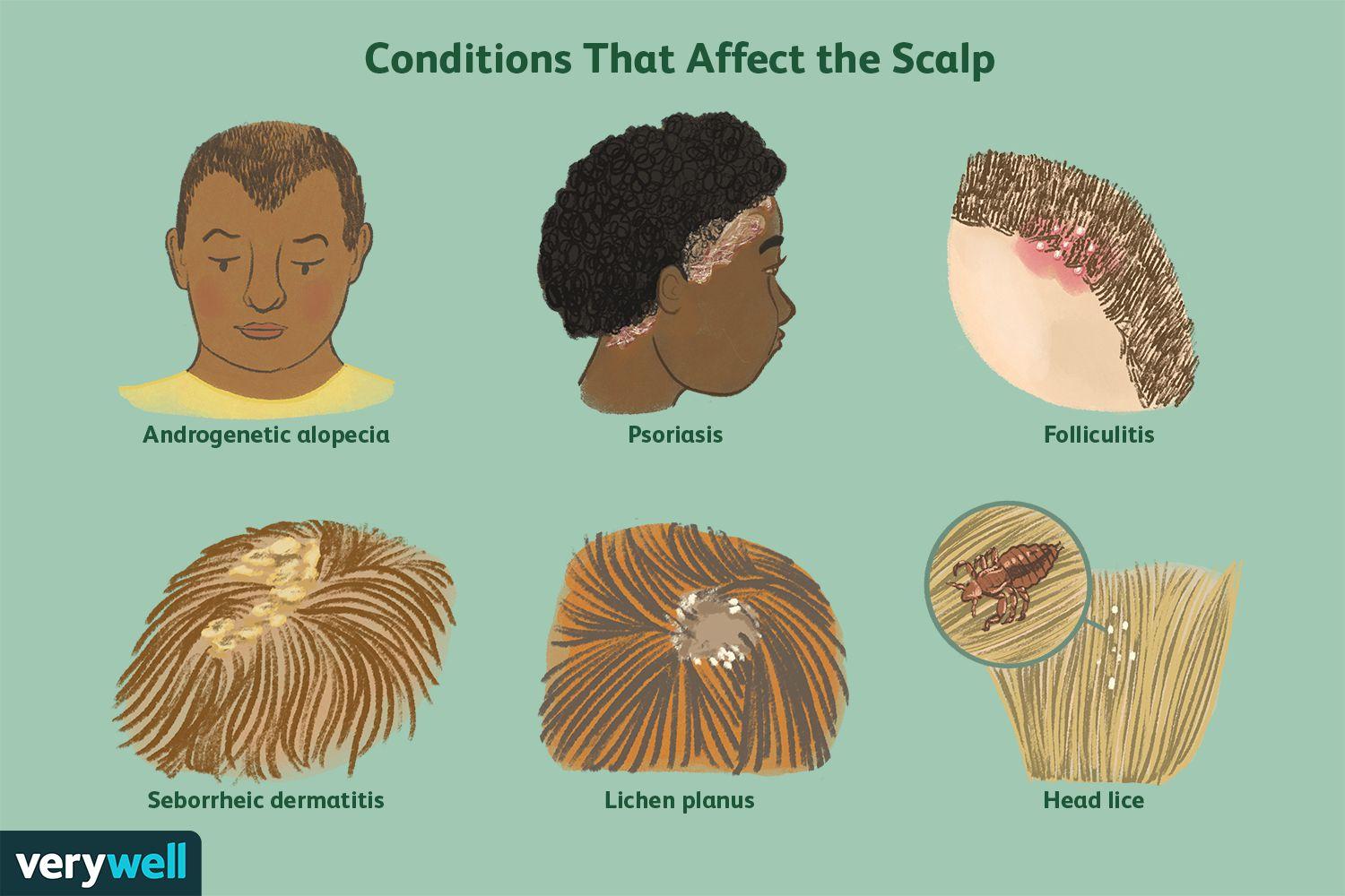 What Diseases Affect the Scalp? 12 67d5ec9549ac4466a198af17e4fc6c41 67d5ec9549ac4466a198af17e4fc6c41