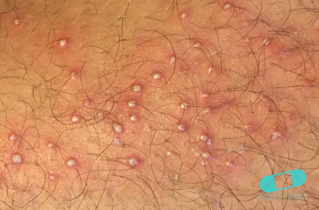 Is Folliculitis an Std? 1 77467a1d7d764a25b920f5d7854db045 77467a1d7d764a25b920f5d7854db045