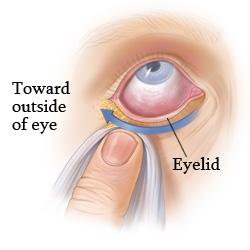 How to Take Care of Pink Eye 11 a4166dc158d3452b815f94aeb8bac615 a4166dc158d3452b815f94aeb8bac615