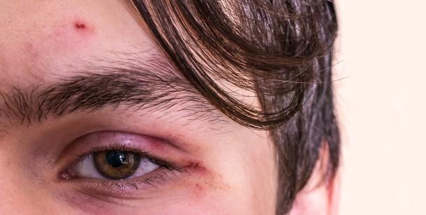 How Should You Care for Cuts of the Eye Or Lid? 13 a5aeb608a4924659966b9d76599b0d1c a5aeb608a4924659966b9d76599b0d1c