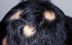 What Types of Hair Diseases are There? 15 ca4594ee24334bfeb2418897f2cf96f0 ca4594ee24334bfeb2418897f2cf96f0