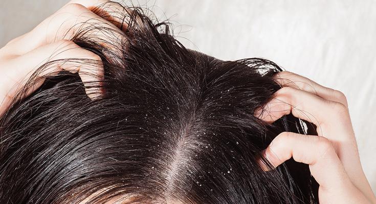 What are the Symptoms of Hair Infection? 13 cd3bc3c97acc43d48d59be4a91d43d10 cd3bc3c97acc43d48d59be4a91d43d10