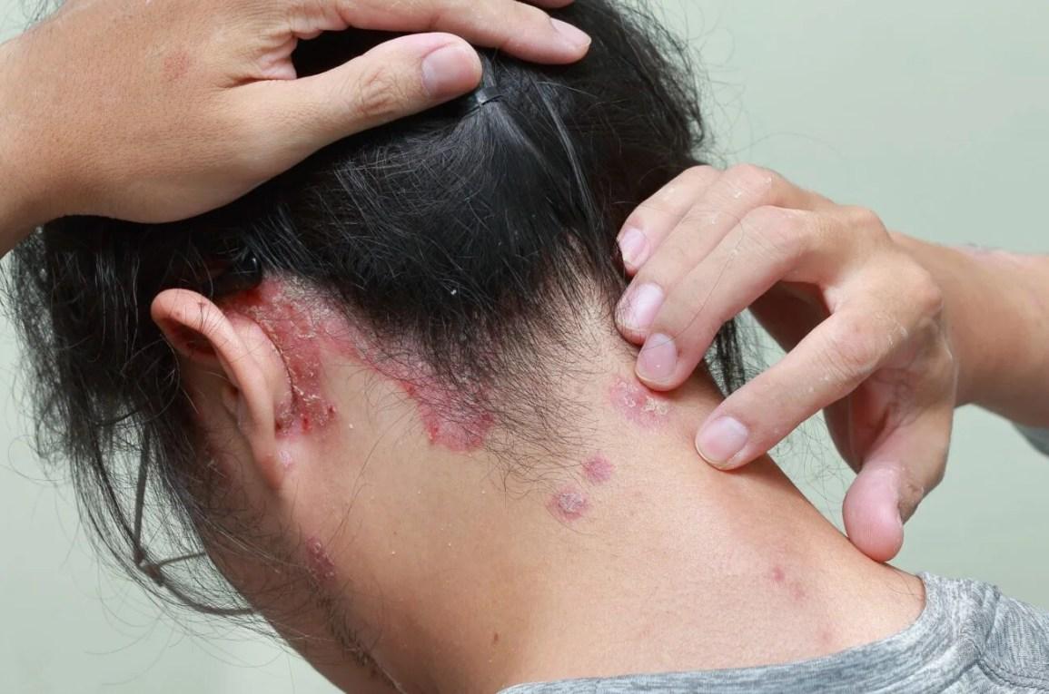 How Do You Identify Scalp Diseases? 17 d2db21d9fa2b4b939c0220158f58805a d2db21d9fa2b4b939c0220158f58805a