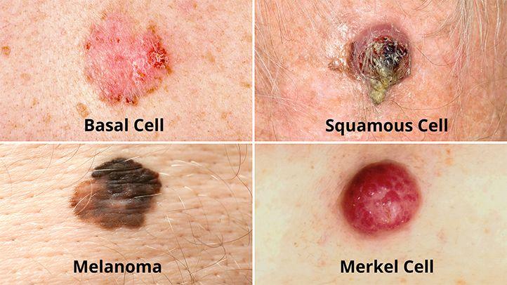 Types of Skin Cancer 1 dffe10d6827045ef879f6ada63f760de dffe10d6827045ef879f6ada63f760de
