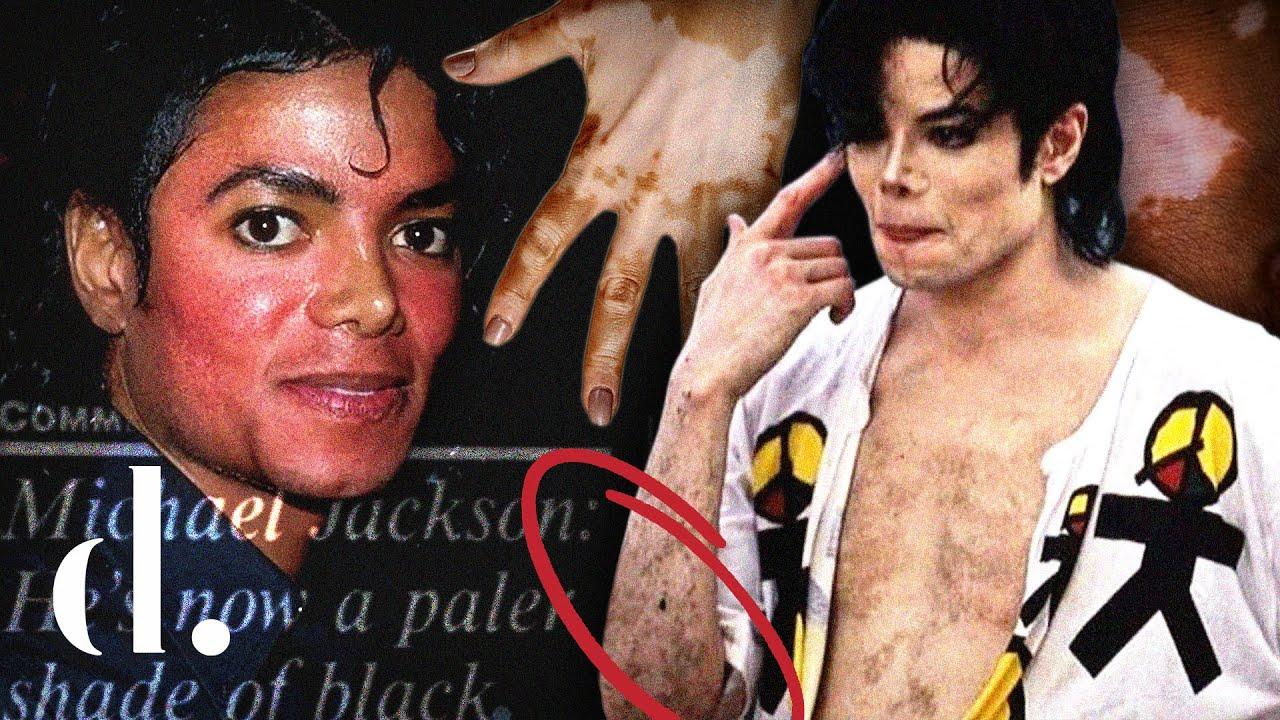 Did Michael Jackson Have A Skin Disease   Ed4632ce08ab468db25fd36578df1f7a 