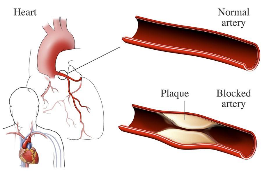 Understanding Coronary Heart Diseases 2 15e1b00ddf4b43ab8ffecb86b4204edb 15e1b00ddf4b43ab8ffecb86b4204edb