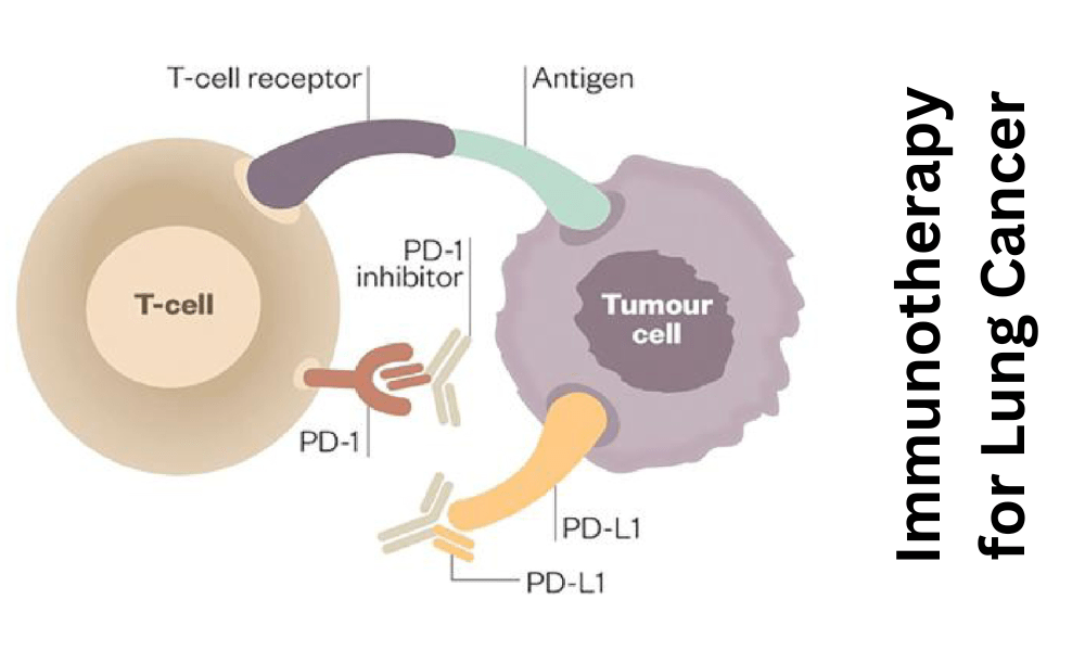 Immunotherapy for Lung Cancer