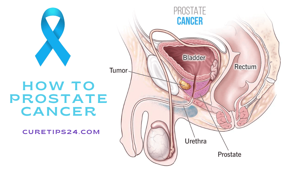 How to Prostate Cancer