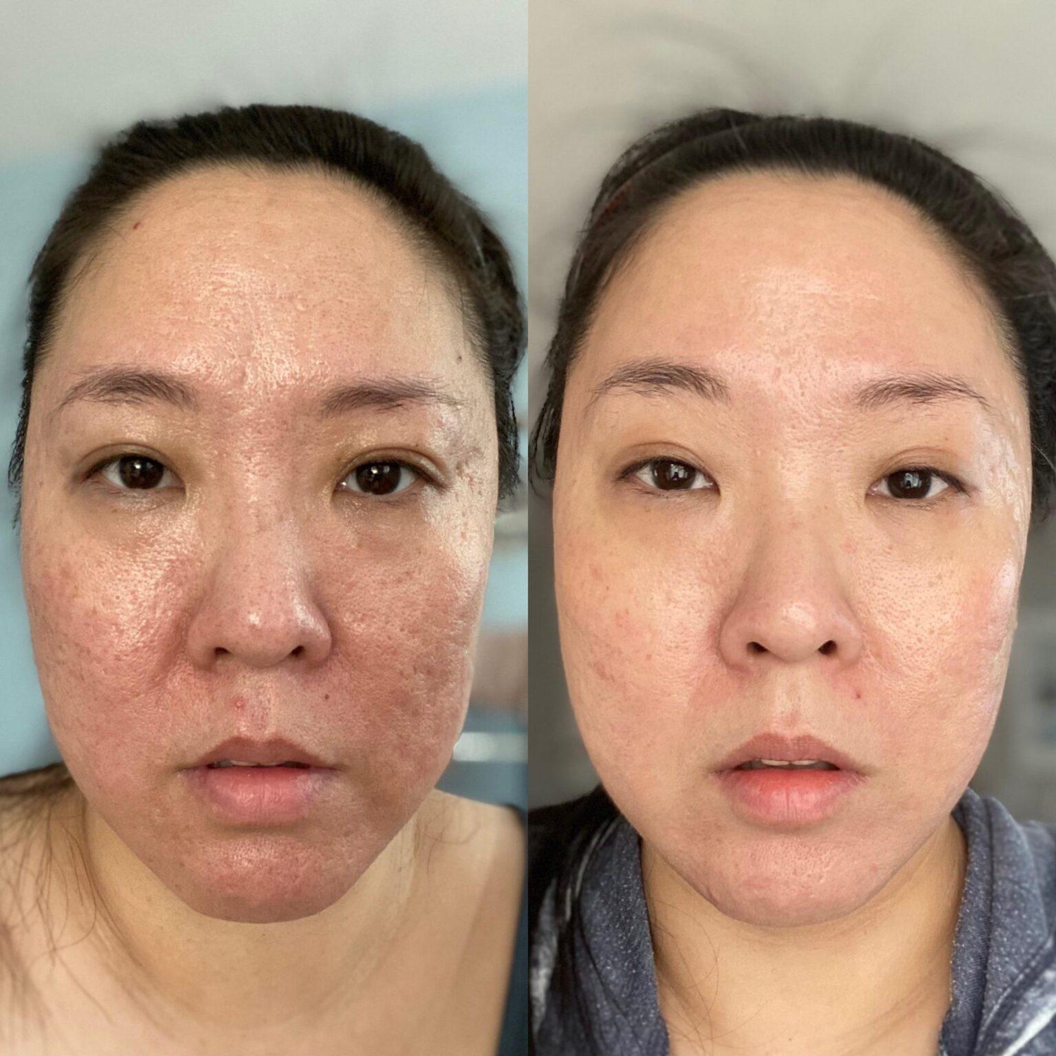 Face Before and After Vitamin C Serum Astonishing Transformation Unveiled!