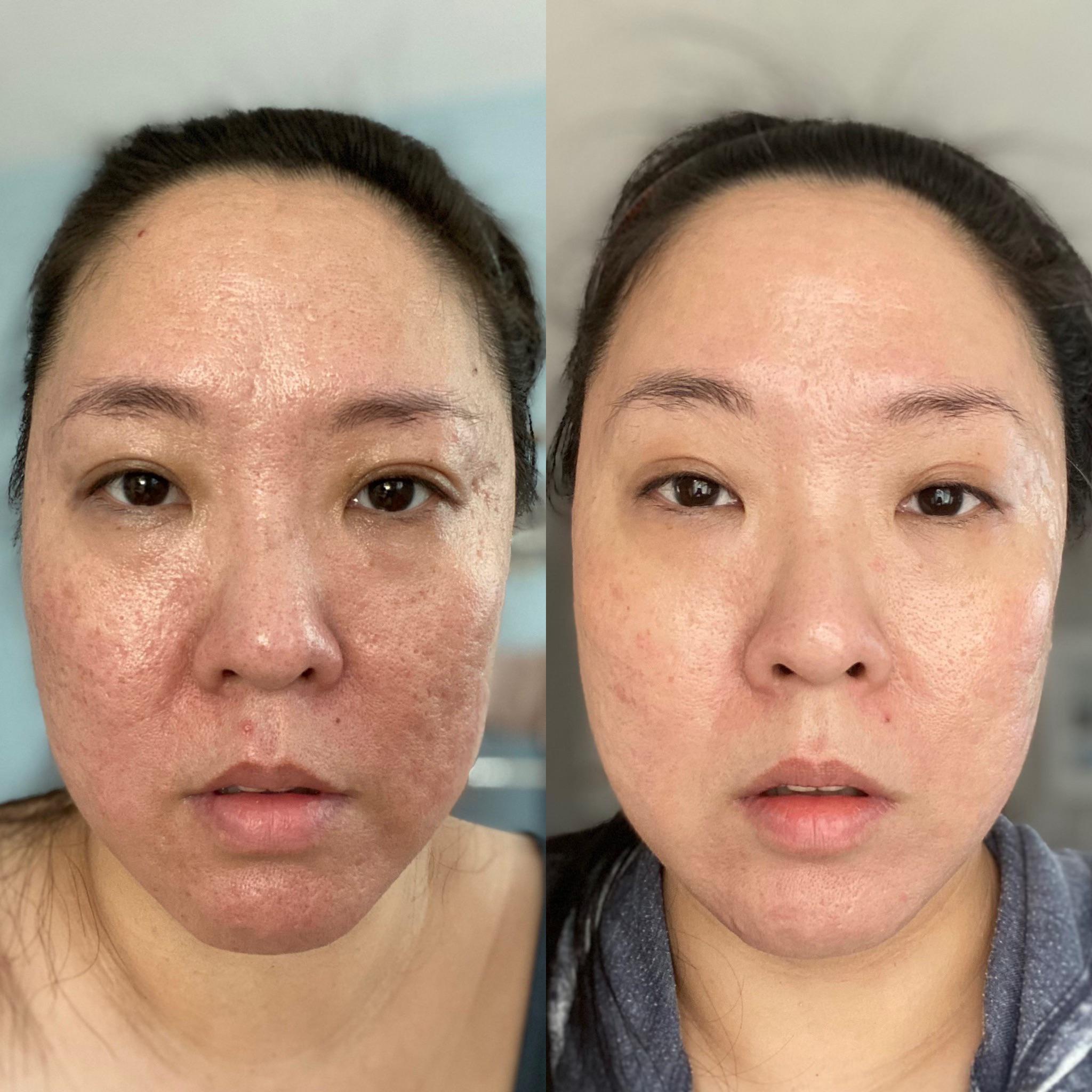 Face before And After Vitamin C Serum