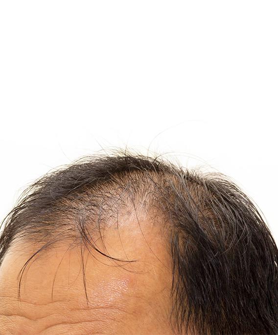 Why Minoxidil Does Not Work for Frontal