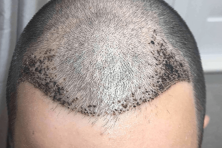 When is the best time to get a hair transplant? Understanding Ideal Timing 6 image 43 image 43